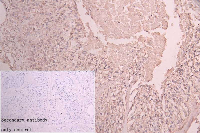Immunohistochemistry of paraffin-embedded human pancreatic tissue using ZDHHC4 Antibody at dilution of 1:100Rabbit anti-Human ZDHHC4 Polyclonal Antibody