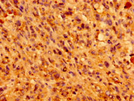 Immunohistochemistry of paraffin-embedded human melanoma using IFT46 Antibody at dilution of 1:100Rabbit anti-Human IFT46 Polyclonal Antibody