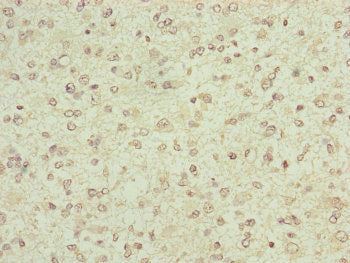 Immunohistochemistry of paraffin-embedded human glioma using FBXO6 Antibody at dilution of 1:100Rabbit anti-Human FBXO6 Polyclonal Antibody