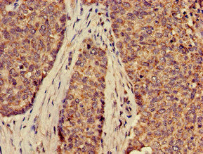 Immunohistochemistry of paraffin-embedded human ovarian cancer using SLC2A9 Antibody at dilution of 1:100Rabbit anti-Human SLC2A9 Polyclonal Antibody