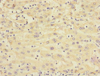Immunohistochemistry of paraffin-embedded human liver cancer using RXFP3 Antibody at dilution of 1:100Rabbit anti-Human RXFP3 Polyclonal Antibody