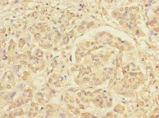 Immunohistochemistry of paraffin-embedded human pancreatic cancer using RXFP3 Antibody at dilution of 1:100Rabbit anti-Human RXFP3 Polyclonal Antibody