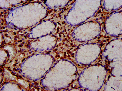 IHC image of the antibody diluted at 1:400 and staining in paraffin-embedded human gastric cancer performed on a Leica BondTM system. After dewaxing and hydration, antigen retrieval was mediated by high pressure in a citrate buffer (pH 6.0). Section was blocked with 10% normal goat serum 30min at RT. Then primary antibody (1% BSA) was incubated at 4°C overnight. The primary is detected by a biotinylated secondary antibody and visualized using an HRP conjugated SP system.Rabbit anti-Human CUTC Polyclonal Antibody