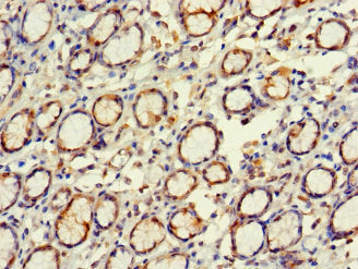 Immunohistochemistry of paraffin-embedded human gastric cancer using EXD2 Antibody at dilution of 1:100Rabbit anti-Human EXD2 Polyclonal Antibody