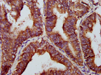 IHC image of the antibody diluted at 1:200 and staining in paraffin-embedded human endometrial cancer performed on a Leica BondTM system. After dewaxing and hydration, antigen retrieval was mediated by high pressure in a citrate buffer (pH 6.0). Section was blocked with 10% normal goat serum 30min at RT. Then primary antibody (1% BSA) was incubated at 4°C overnight. The primary is detected by a biotinylated secondary antibody and visualized using an HRP conjugated SP system.