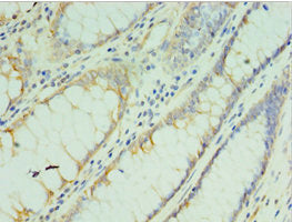 Immunohistochemistry of paraffin-embedded human colon cancer using TMOD3 Antibody at dilution of 1:100Rabbit anti-Human TMOD3 Polyclonal Antibody