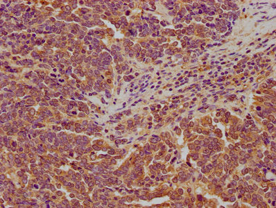 IHC image of LARS Antibody diluted at 1:200 and staining in paraffin-embedded human lung cancer performed on a Leica BondTM system. After dewaxing and hydration, antigen retrieval was mediated by high pressure in a citrate buffer (pH 6.0). Section was blocked with 10% normal goat serum 30min at RT. Then primary antibody (1% BSA) was incubated at 4°C overnight. The primary is detected by a biotinylated secondary antibody and visualized using an HRP conjugated SP system.