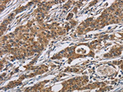 The image is immunohistochemistry of paraffin-embedded Human gastric cancer tissue using AGER Antibody(AGER Antibody) at dilution 1/70. (Original magnification: ×200)Rabbit anti-Human AGER Polyclonal Antibody