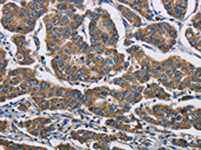 The image is immunohistochemistry of paraffin-embedded Human breast cancer tissue using the antibody Antibody) at dilution 1/70. (Original magnification: ×200)Rabbit anti-Human AGER Polyclonal Antibody