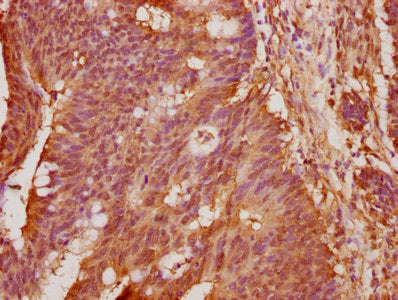 IHC image of the antibody diluted at 1:100 and staining in paraffin-embedded human colon cancer performed on a Leica BondTM system. After dewaxing and hydration, antigen retrieval was mediated by high pressure in a citrate buffer (pH 6.0). Section was blocked with 10% normal goat serum 30min at RT. Then primary antibody (1% BSA) was incubated at 4°C overnight. The primary is detected by a biotinylated secondary antibody and visualized using an HRP conjugated SP system.Rabbit anti-Human AIFM2 Polyclonal Antibody