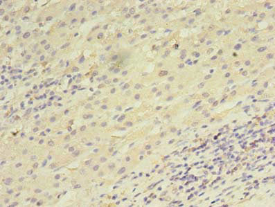 Immunohistochemistry of paraffin-embedded human liver cancer using UTP23 Antibody at dilution of 1:100Rabbit anti-Human UTP23 Polyclonal Antibody
