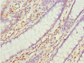 Immunohistochemistry of paraffin-embedded human colon cancer using CNPY3 Antibody at dilution of 1:100Rabbit anti-Human CNPY3 Polyclonal Antibody