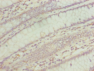 Immunohistochemistry of paraffin-embedded human colon cancer using the antibody at dilution of 1:100Rabbit anti-Human TMEM243 Polyclonal Antibody