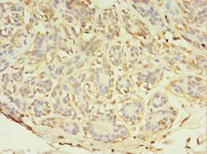 Immunohistochemistry of paraffin-embedded human breast cancer using the antibody at dilution of 1:100