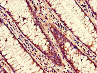 Immunohistochemistry of paraffin-embedded human colon cancer using NUP85 Antibody at dilution of 1:100Rabbit anti-Human NUP85 Polyclonal Antibody