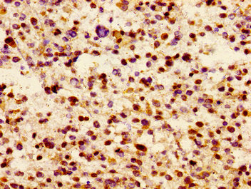 Immunohistochemistry of paraffin-embedded human glioma using JAM3 Antibody at dilution of 1:100