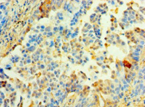 Immunohistochemistry of paraffin-embedded human lung cancer using MRPL1 Antibody at dilution of 1:100Rabbit anti-Human MRPL1 Polyclonal Antibody