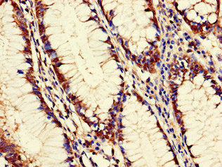 Immunohistochemistry of paraffin-embedded human colon cancer using PANK2 Antibody at dilution of 1:100Rabbit anti-Human PANK2 Polyclonal Antibody
