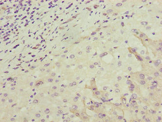 Immunohistochemistry of paraffin-embedded human liver cancer using the antibody at dilution of 1:100Rabbit anti-Human OR2H1 Polyclonal Antibody