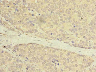Immunohistochemistry of paraffin-embedded human gastric cancer using C20orf27 Antibody at dilution of 1: 100