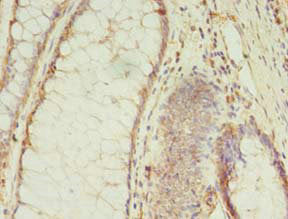 Immunohistochemistry of paraffin-embedded human colon cancer using the antibody at dilution of 1:100