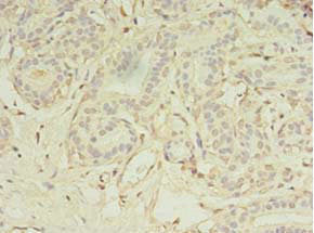 Immunohistochemistry of paraffin-embedded human breast cancer using MS4A7 Antibody at dilution of 1:100Rabbit anti-Human MS4A7 Polyclonal Antibody
