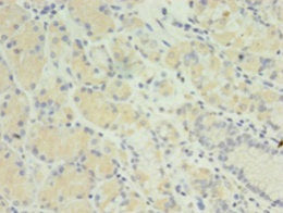 Immunohistochemistry of paraffin-embedded human gastric cancer using MIS12 Antibody at dilution of 1:100