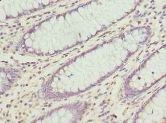 Immunohistochemistry of paraffin-embedded human colon cancer using CXXC4 Antibody at dilution of 1:100Rabbit anti-Human CXXC4 Polyclonal Antibody