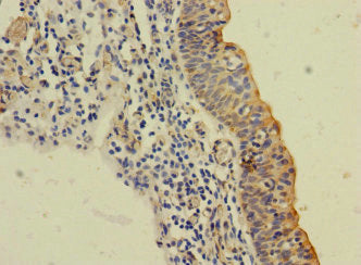 Immunohistochemistry of paraffin-embedded human bladder cancer using the antibody at dilution of 1:100Rabbit anti-Human SLC6A15 Polyclonal Antibody