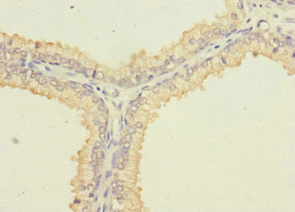 Immunohistochemistry of paraffin-embedded human prostate cancer using SLC6A15 Antibody at dilution of 1:100Rabbit anti-Human SLC6A15 Polyclonal Antibody