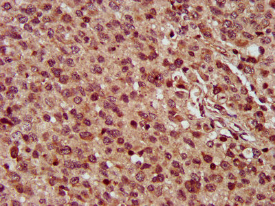 IHC image of the antibody diluted at 1:300 and staining in paraffin-embedded human glioma performed on a Leica BondTM system. After dewaxing and hydration, antigen retrieval was mediated by high pressure in a citrate buffer (pH 6.0). Section was blocked with 10% normal goat serum 30min at RT. Then primary antibody (1% BSA) was incubated at 4°C overnight. The primary is detected by a biotinylated secondary antibody and visualized using an HRP conjugated SP system.Rabbit anti-Human MMADHC Polyclonal Antibody