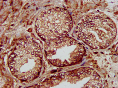 IHC image of MMADHC Antibody diluted at 1:300 and staining in paraffin-embedded human prostate cancer performed on a Leica BondTM system. After dewaxing and hydration, antigen retrieval was mediated by high pressure in a citrate buffer (pH 6.0). Section was blocked with 10% normal goat serum 30min at RT. Then primary antibody (1% BSA) was incubated at 4°C overnight. The primary is detected by a biotinylated secondary antibody and visualized using an HRP conjugated SP system.Rabbit anti-Human MMADHC Polyclonal Antibody