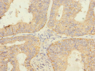 Immunohistochemistry of paraffin-embedded human endometrial cancer using SAV1 Antibody at dilution of 1:100Rabbit anti-Human SAV1 Polyclonal Antibody