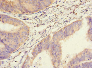 Immunohistochemistry of paraffin-embedded human endometrial cancer using SAV1 Antibody at dilution of 1:100Rabbit anti-Human SAV1 Polyclonal Antibody