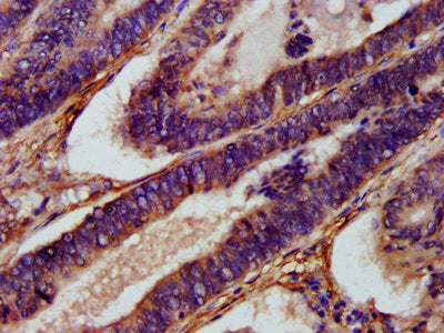IHC image of XKR8 Antibody diluted at 1:1000 and staining in paraffin-embedded human colon cancer performed on a Leica BondTM system. After dewaxing and hydration, antigen retrieval was mediated by high pressure in a citrate buffer (pH 6.0). Section was blocked with 10% normal goat serum 30min at RT. Then primary antibody (1% BSA) was incubated at 4°C overnight. The primary is detected by a biotinylated secondary antibody and visualized using an HRP conjugated SP system.Rabbit anti-Human XKR8 Polyclonal Antibody