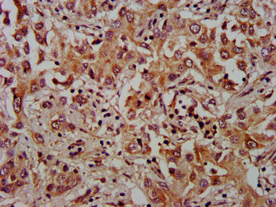 IHC image of XKR8 Antibody diluted at 1:1000 and staining in paraffin-embedded human liver cancer performed on a Leica BondTM system. After dewaxing and hydration, antigen retrieval was mediated by high pressure in a citrate buffer (pH 6.0). Section was blocked with 10% normal goat serum 30min at RT. Then primary antibody (1% BSA) was incubated at 4°C overnight. The primary is detected by a biotinylated secondary antibody and visualized using an HRP conjugated SP system.Rabbit anti-Human XKR8 Polyclonal Antibody