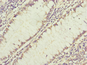 Immunohistochemistry of paraffin-embedded human colon cancer using GRPEL1 Antibody at dilution of 1:100Rabbit anti-Human GRPEL1 Polyclonal Antibody