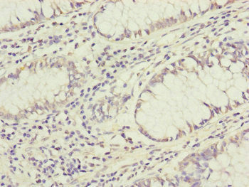 Immunohistochemistry of paraffin-embedded human colon cancer using GRPEL1 Antibody at dilution of 1:100Rabbit anti-Human GRPEL1 Polyclonal Antibody