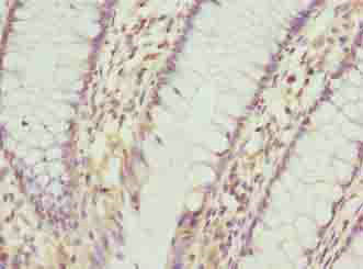 Immunohistochemistry of paraffin-embedded human colon cancer using PLGRKT Antibody at dilution of 1:100Rabbit anti-Human PLGRKT Polyclonal Antibody