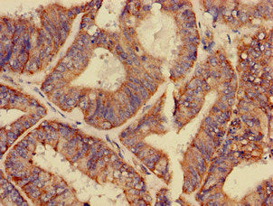Immunohistochemistry of paraffin-embedded human endometrial cancer using the antibody at dilution of 1:100Rabbit anti-Human GPAM Polyclonal Antibody
