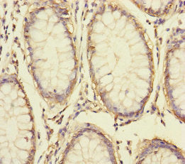 Immunohistochemistry of paraffin-embedded human colon cancer using S100A14 Antibody at dilution of 1:100Rabbit anti-Human S100A14 Polyclonal Antibody