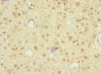 Immunohistochemistry of paraffin-embedded human glioma using NRXN3 Antibody at dilution of 1:100Rabbit anti-Human NRXN3 Polyclonal Antibody
