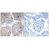 Immunohistochemistry analysis of paraffin-embedded human liver carcinoma tissue using SLC27A5 antibody.Rabbit anti-Human SLC27A5 Polyclonal Antibody