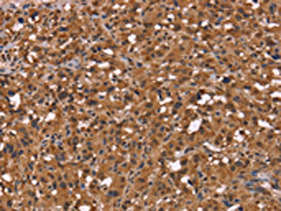 The image on the left is immunohistochemistry of paraffin-embedded Human thyroid cancer tissue using the antibody Antibody) at dilution 1/50, on the right is treated with synthetic peptide. (Original magnification: X200)