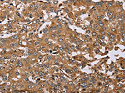 The image on the left is immunohistochemistry of paraffin-embedded Human liver cancer tissue using the antibody Antibody) at dilution 1/50, on the right is treated with synthetic peptide. (Original magnification: ×200)Rabbit anti-Human DDAH1 Polyclonal Antibody
