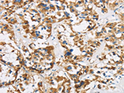 The image is immunohistochemistry of paraffin-embedded Human thyroid cancer tissue using the antibody Antibody) at dilution 1/50. (Original magnification: ×200)Rabbit anti-Human COX6B1 Polyclonal Antibody