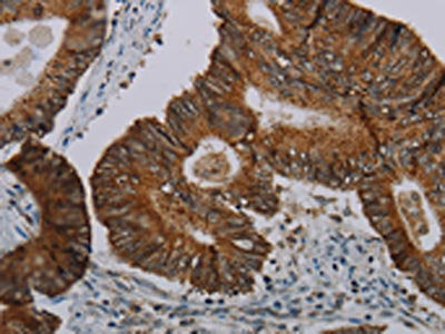 The image on the left is immunohistochemistry of paraffin-embedded Human colon cancer tissue using CFLAR Antibody(CFLAR Antibody) at dilution 1/20, on the right is treated with synthetic peptide. (Original magnification: ×200)Rabbit anti-Human CFLAR Polyclonal Antibody