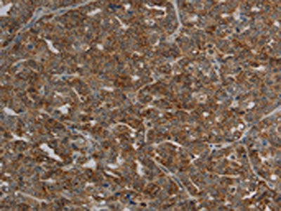 The image on the left is immunohistochemistry of paraffin-embedded Human ovarian cancer tissue using the antibody Antibody) at dilution 1/20, on the right is treated with synthetic peptide. (Original magnification: ×200)Rabbit anti-Human CFLAR Polyclonal Antibody