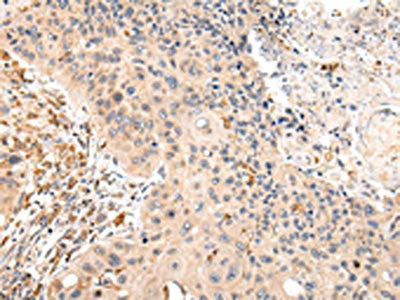 The image on the left is immunohistochemistry of paraffin-embedded Human esophagus cancer tissue using VIL1 Antibody(VIL1 Antibody) at dilution 1/25, on the right is treated with fusion protein. (Original magnification: ×200)Rabbit anti-Human VIL1 Polyclonal Antibody