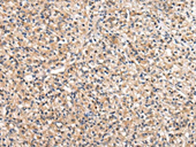 The image on the left is immunohistochemistry of paraffin-embedded Human prostate cancer tissue using the antibody Antibody) at dilution 1/25, on the right is treated with fusion protein. (Original magnification: ×200)Rabbit anti-Human VIL1 Polyclonal Antibody